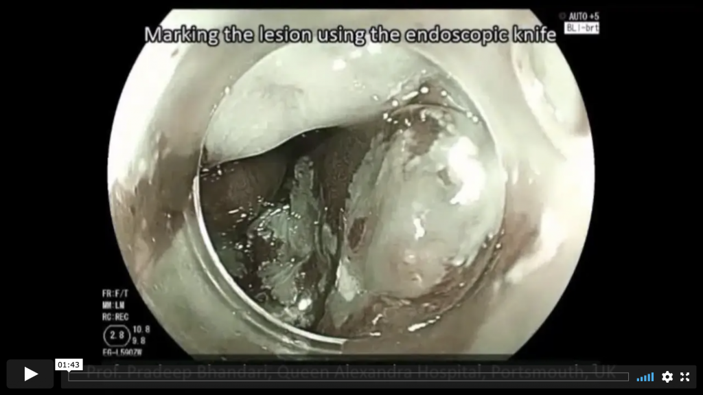 Endoscopic Submucosal Dissection of Barrett's Intramucosal Cancer